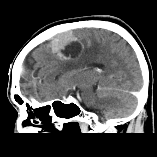 Atypical meningioma (WHO grade II) with osseous invasion (Radiopaedia 53654-59715 G 24).png