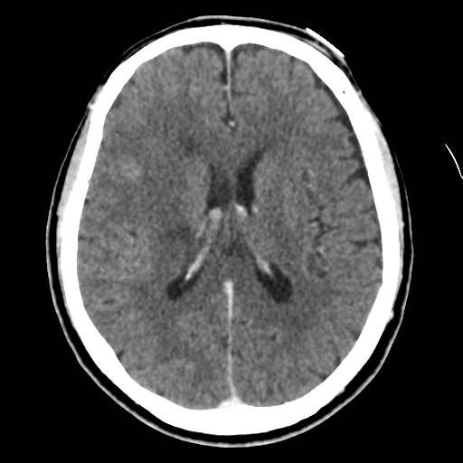 File:Atypical meningioma with skull invasion (Radiopaedia 34357-35649 Axial C+ delayed 31).png