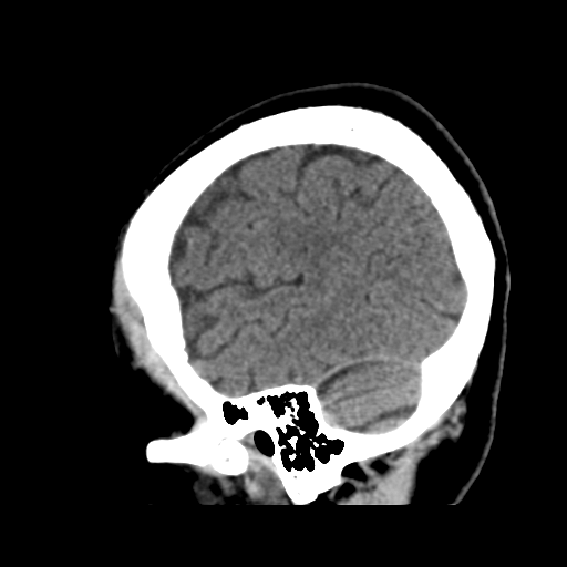 Atypical meningioma with skull invasion (Radiopaedia 34357-35649 E 45).png