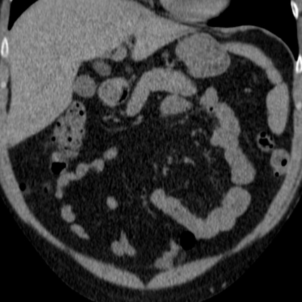 File:Autosomal dominant polycystic kidney disease (Radiopaedia 36539-38101 Coronal non-contrast 3).jpg