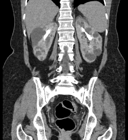 Autosomal dominant polycystic kidney disease (Radiopaedia 38189-40194 Coronal C+ delayed 72).jpg