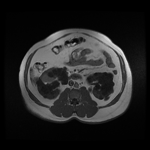 File:Autosomal dominant polycystic kidney disease (Radiopaedia 50259-55611 Axial 2D Dual Echo 52).jpg