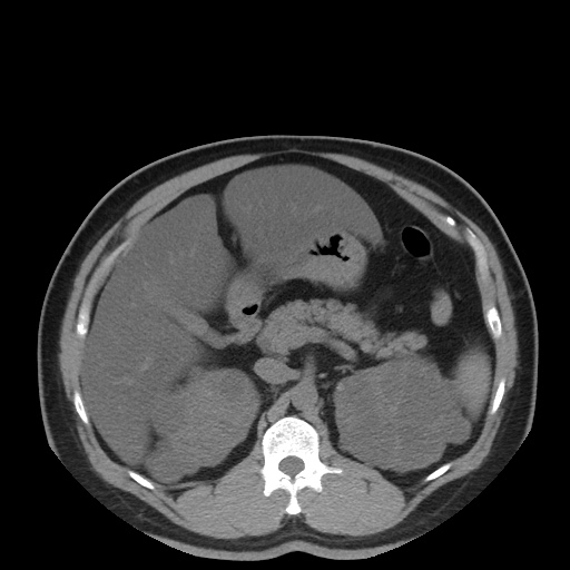 Autosomal dominant polycystic kidney disease (Radiopaedia 50259-55612 Axial non-contrast 31).jpg