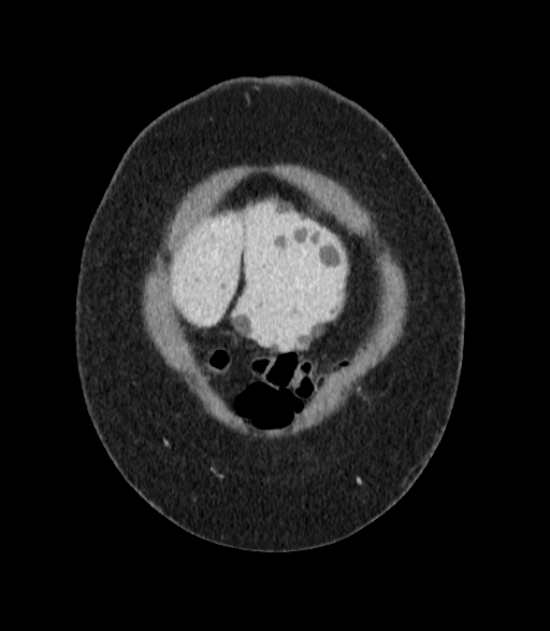 Autosomal dominant polycystic kidney disease (Radiopaedia 57124-64017 B 2).jpg