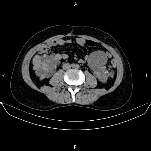 Autosomal dominant polycystic kidney disease (Radiopaedia 87830-104287 Axial non-contrast 32).jpg
