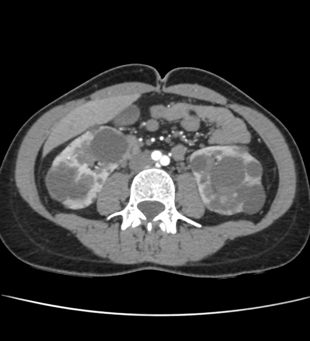 Autosomal dominant polycystic kidney disease - early onset (Radiopaedia 40734-43387 B 39).jpg