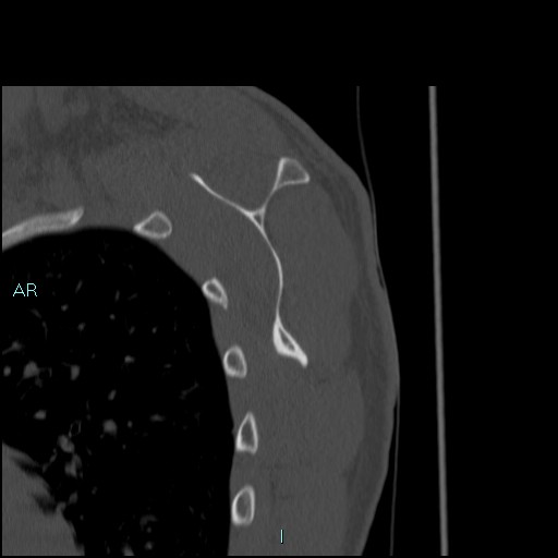 Avascular necrosis after fracture dislocations of the proximal humerus (Radiopaedia 88078-104653 Sagittal bone window 59).jpg