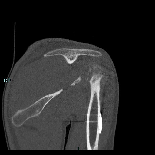 Avascular necrosis after fracture dislocations of the proximal humerus (Radiopaedia 88078-104655 Coronal bone window 61).jpg