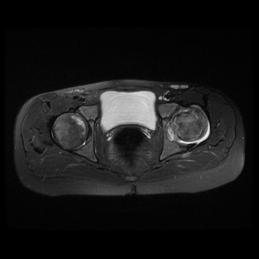 File:Avascular necrosis of the hip (Radiopaedia 29563-30067 Axial T2 fat sat 7).jpg