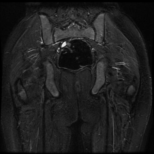 File:Avascular necrosis of the hip (Radiopaedia 29563-30067 Coronal T2 fat sat 14).jpg
