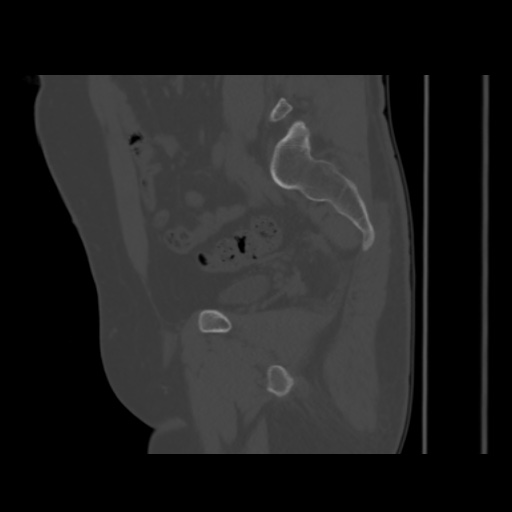 Avascular necrosis of the hip (Radiopaedia 61503-69467 B 24).jpg