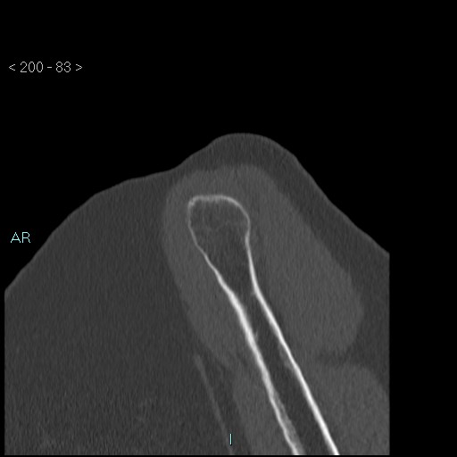Avascular necrosis of the shoulder - Cruess stage I (Radiopaedia 77674-89887 Sagittal bone window 82).jpg