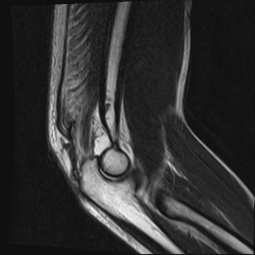 File:Avulsion of the triceps tendon (Radiopaedia 42919-46154 Sagittal T2 3).jpg