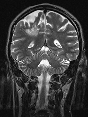 Balo concentric sclerosis (Radiopaedia 50458-55940 Coronal T2 36).jpg