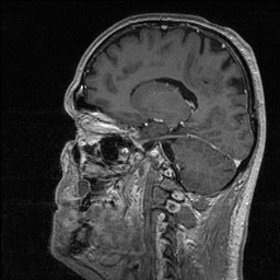 File:Balo concentric sclerosis (Radiopaedia 50458-55940 Sagittal T1 C+ 63).jpg