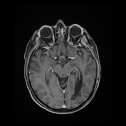 Balo concentric sclerosis (Radiopaedia 53875-59982 Axial LAVA C+ 114).jpg