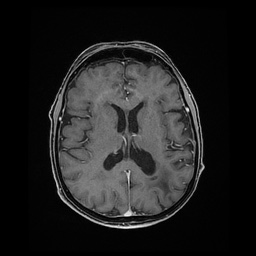 Balo concentric sclerosis (Radiopaedia 53875-59982 Axial LAVA C+ 152).jpg