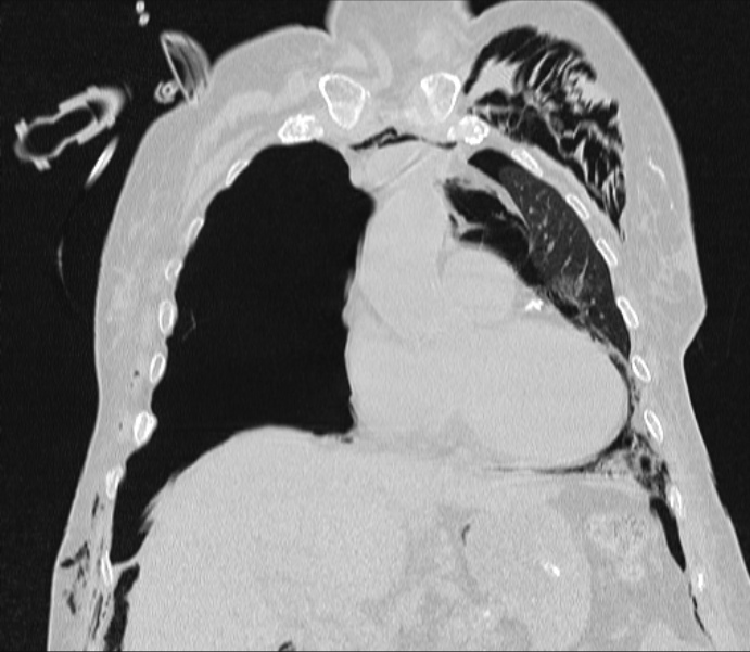 Barotrauma due to mechanical ventilation (Radiopaedia 28079-28336 Coronal lung window 38).jpg