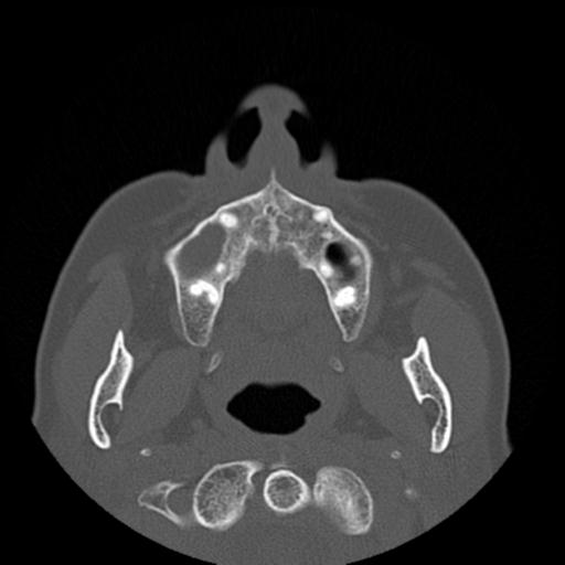 File:Base of skull chondrosarcoma (Radiopaedia 30410-31071 Axial bone window 4).jpg