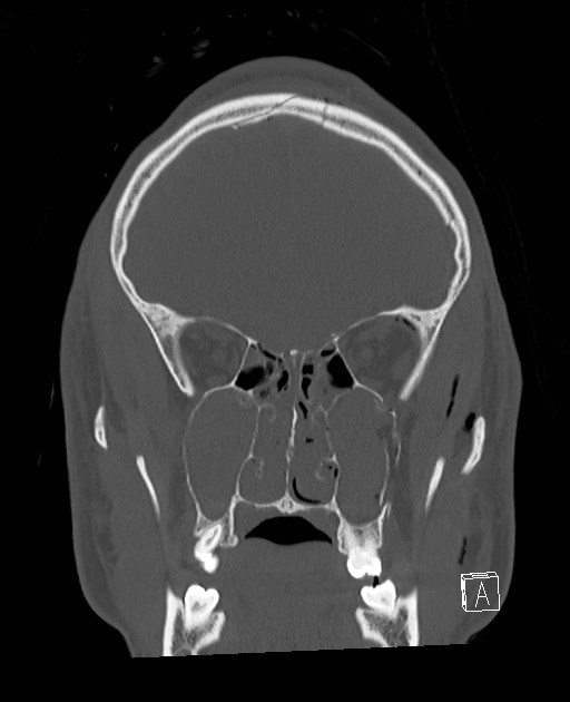 Base of skull fracture with bilateral Le Fort fractures (Radiopaedia 47094-51638 Coronal bone window 70).jpg