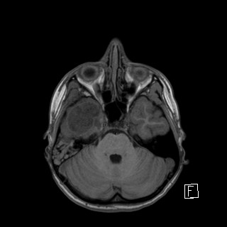 File:Base of skull rhabdomyosarcoma (Radiopaedia 32196-33142 Axial T1 14).jpg
