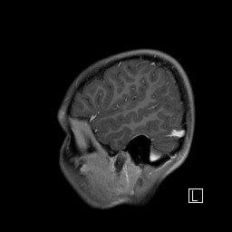 Base of skull rhabdomyosarcoma (Radiopaedia 32196-33142 J 51).jpg