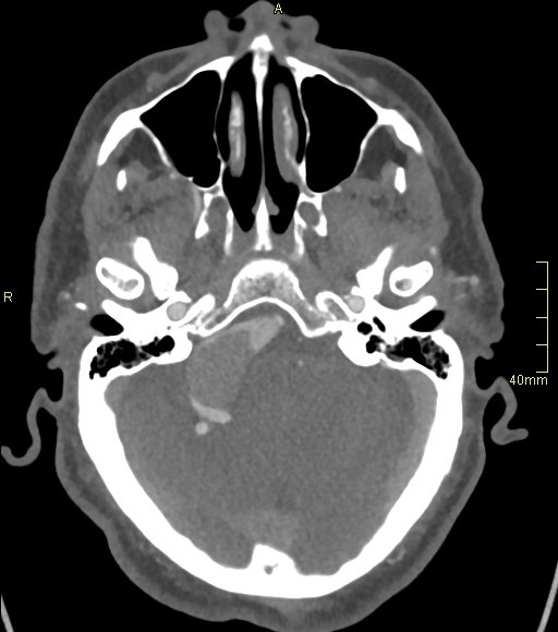 File:Basilar artery aneurysm (Radiopaedia 56261-62932 A 50).jpg