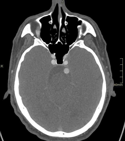 File:Basilar artery aneurysm (Radiopaedia 56261-62932 A 64).jpg