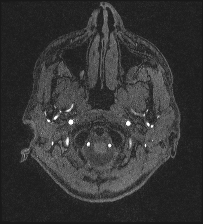 Basilar artery perforator aneurysm (Radiopaedia 82455-97733 Axial MRA 13).jpg