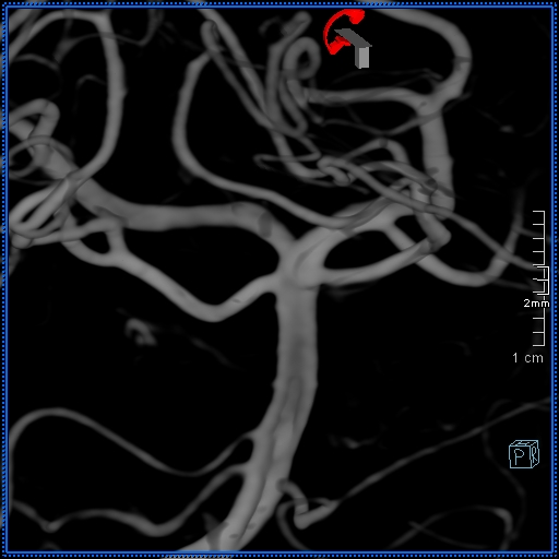 Basilar artery perforator aneurysm (Radiopaedia 82455-99524 3D Left VA 82).jpg