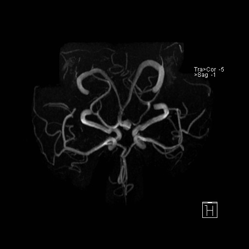 Basilar tip aneurysm (Radiopaedia 26504-26632 D 20).jpg