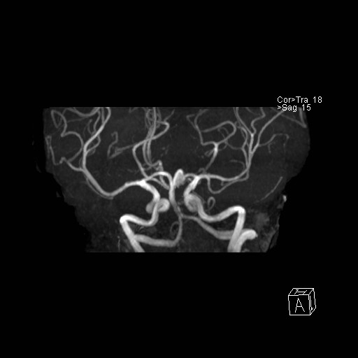 Basilar tip aneurysm (Radiopaedia 26504-26632 D 32).jpg