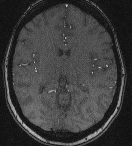 Basilar tip aneurysm (Radiopaedia 26504-26632 MRA 133).jpg