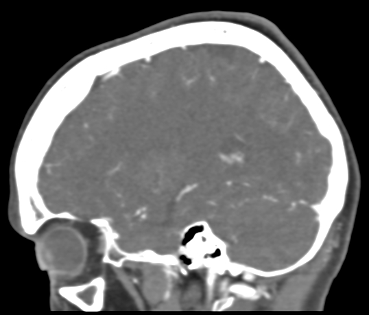 Basilar tip aneurysm with coiling (Radiopaedia 53912-60086 C 95).jpg