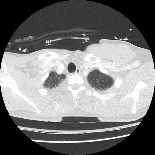 File:Benign post-traumatic pseudopneumoperitoneum (Radiopaedia 71199-81495 Axial lung window 16).jpg