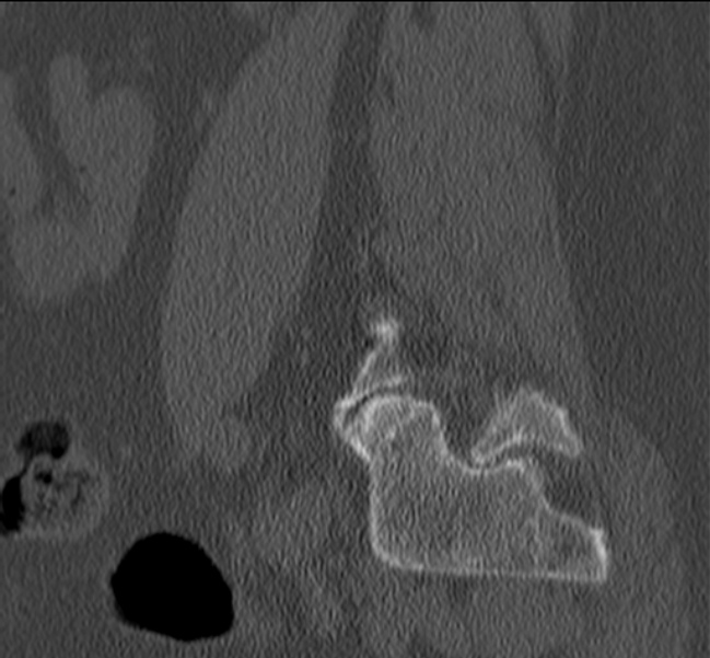 Bertolotti syndrome (Radiopaedia 24864-25128 Sagittal bone window 48).jpg