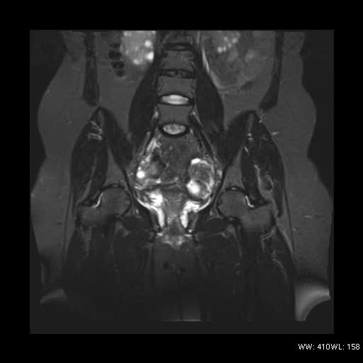 File:Bicornuate uterus- on MRI (Radiopaedia 49206-54297 Coronal STIR 9).jpg
