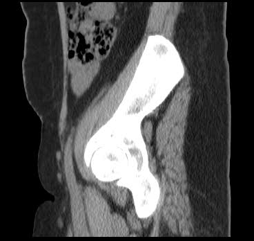File:Bicornuate uterus (MRI) (Radiopaedia 49206-54296 Sagittal 19).png