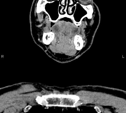 File:Bilateral Warthin tumors (Radiopaedia 84034-99263 C 9).jpg