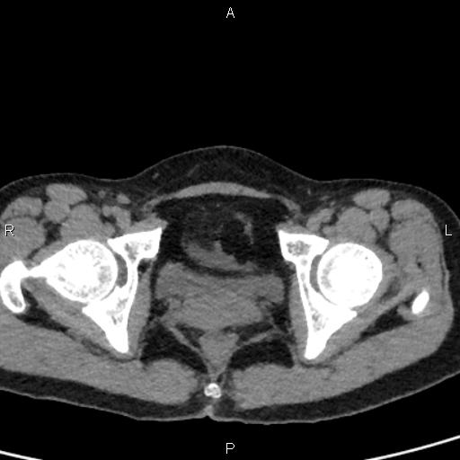 Bilateral adrenal gland hyperenhancement in pancreatitis (Radiopaedia 86642-102753 Axial non-contrast 106).jpg