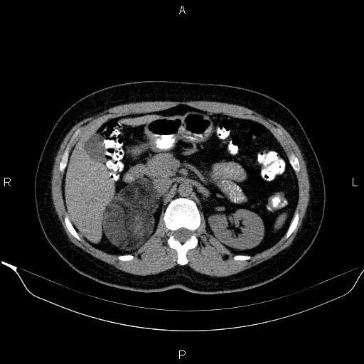 Bilateral adrenal myelolipoma (Radiopaedia 63058-71535 Axial non-contrast 59).jpg