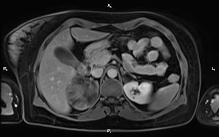 File:Bilateral adrenal myelolipoma (Radiopaedia 63058-71537 H 36).jpg