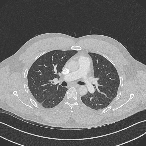 File:Bilateral atelectasis (Radiopaedia 48666-53675 Axial lung window 49).jpg
