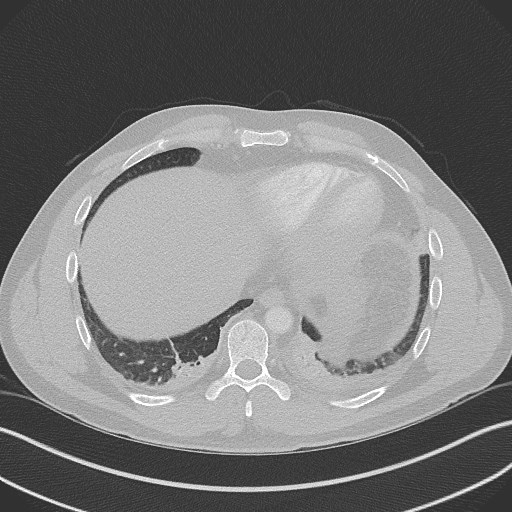 Bilateral atelectasis (Radiopaedia 48666-53675 Axial lung window 89).jpg