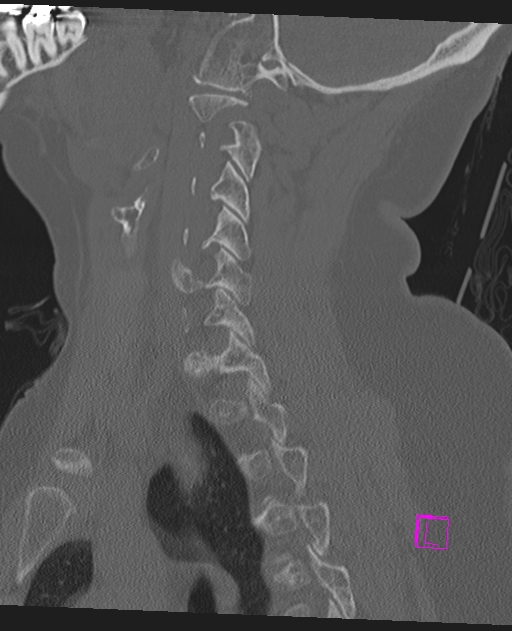 Bilateral atlanto-occipital assimilation (Radiopaedia 28350-28603 Sagittal bone window 52).jpg