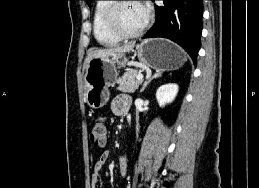 Bilateral benign adrenal adenomas (Radiopaedia 86912-103124 E 62).jpg