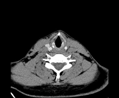 Bilateral carotid body tumors (Radiopaedia 61841-69870 Axial non-contrast 79).jpg