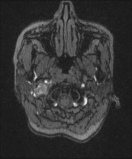 Bilateral carotid body tumors and right glomus jugulare tumor (Radiopaedia 20024-20060 Axial MRA 6).jpg