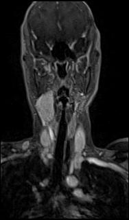 File:Bilateral carotid body tumors and right glomus jugulare tumor (Radiopaedia 20024-20060 MRA 19).jpg