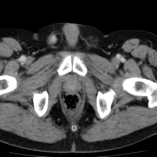 File:Bilateral direct inguinal herniae (Radiopaedia 17016-16719 B 25).jpg